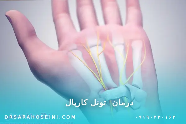درمان سندروم تونل کارپال
