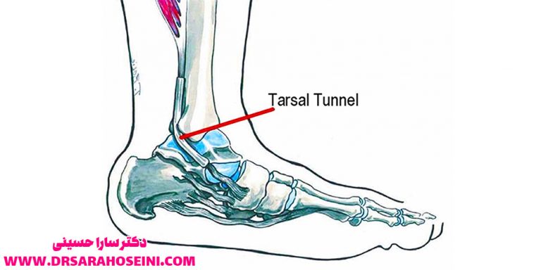 روش های طب فیزیکی برای درمان سندروم تونل تارسال مچ پا