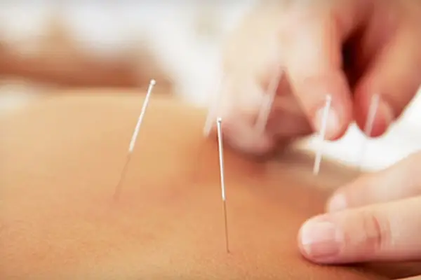 عکس طب سوزنی