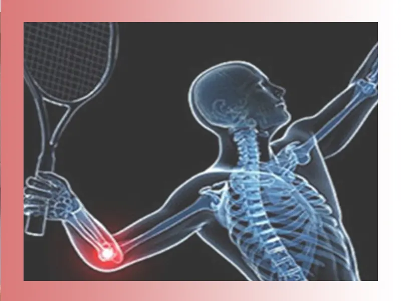 درمان آرنج تنیس بازان