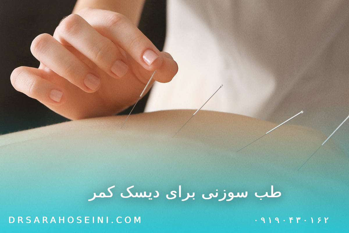 طب سوزنی برای دیسک کمر