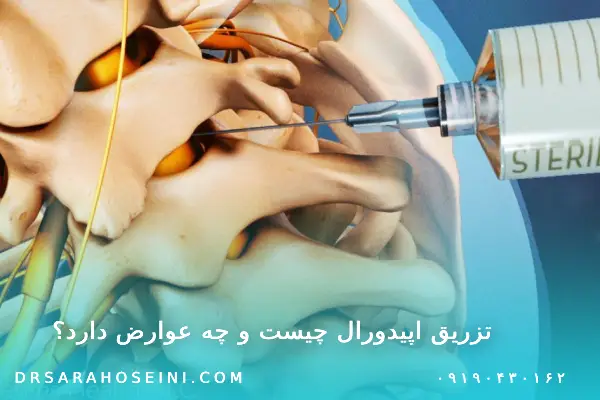 تزریق اپیدورال چیست