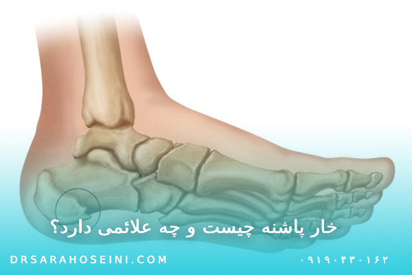 خار پاشنه چیست