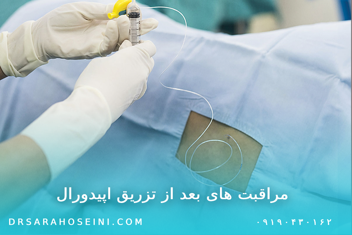 مراقبت‌های بعد از تزریق اپیدورال (کمر)‎