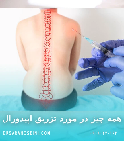 تزریق اپیدورال