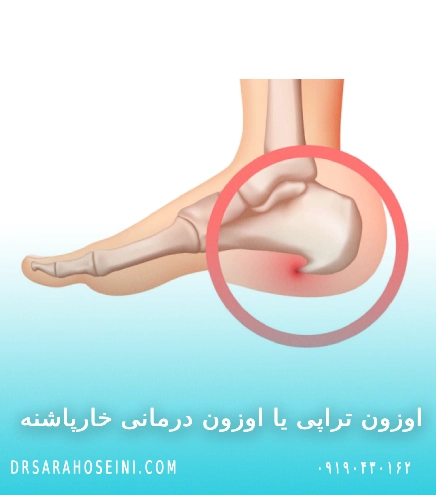 اوزون تراپی خارپاشنه